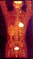 PET scan image