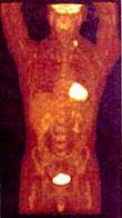 PET scan image